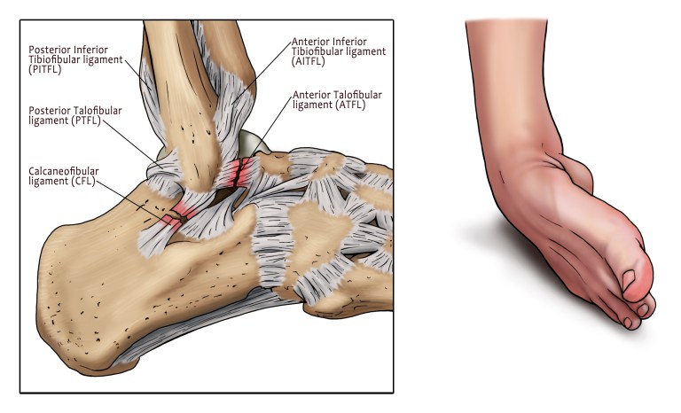 Exercises to prevent ankle sprain